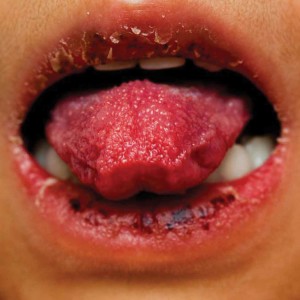 inline-symptom-tongue-lips
