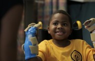 پیوند موفقیت‌آمیز دست بر روی کودک 8 ساله در فیلادلفیا