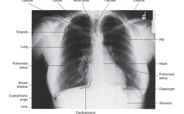 محل ساختارهای موجود در قفسه سینه در یک رادیوگرافی طبیعی (تصویر)